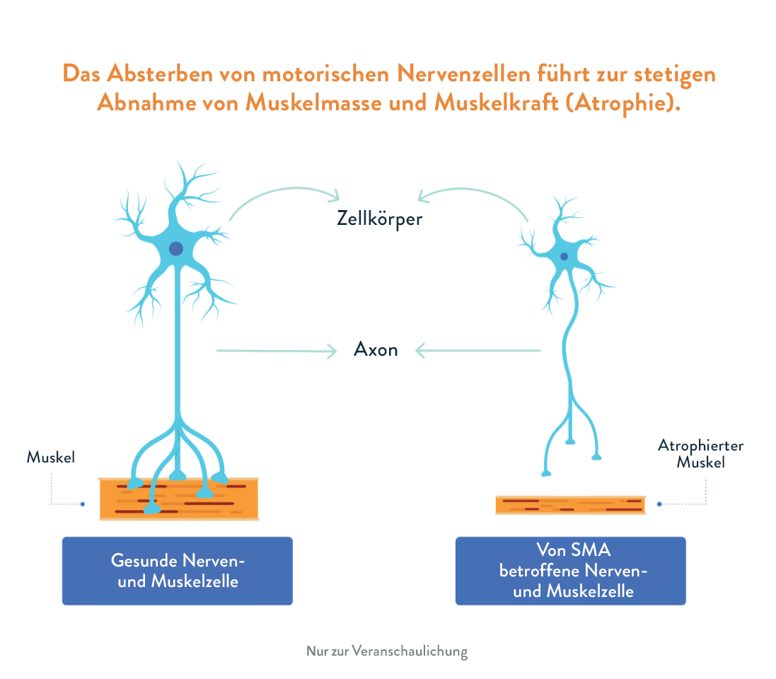Das Absterben von motorischen Nervenzellen führt zur stetigen Abnahme von Muskelmasse und Muskelstärke (Atrophie). 